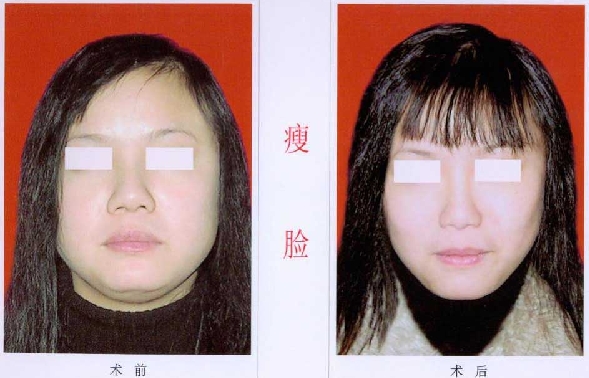 瘦脸针前后对比图