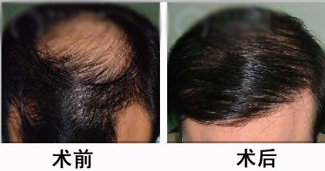 植发手术选择指南