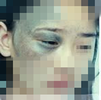 激光去胎记前 激光去胎记前