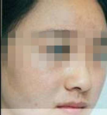 激光去胎记后自信生活 激光去胎记后自信生活