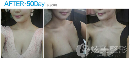 假体隆胸术后50天照片 假体隆胸术后50天照片