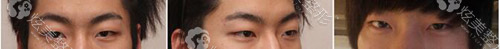开眼角 双眼皮术前 开眼角 双眼皮术前