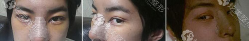 术后五天眼鼻部肿胀 术后五天眼鼻部肿胀