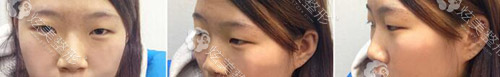 眼鼻整形术前照片 眼鼻整形术前照片