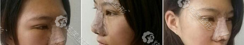 眼鼻整形经历,术后五天仍在肿胀期 眼鼻整形经历,术后五天仍在肿胀期