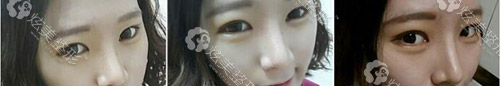 术后14天眼鼻肿胀基本消退 术后14天眼鼻肿胀基本消退