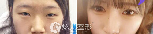 眼鼻整形术后术后对比案例 眼鼻整形术后术后对比案例