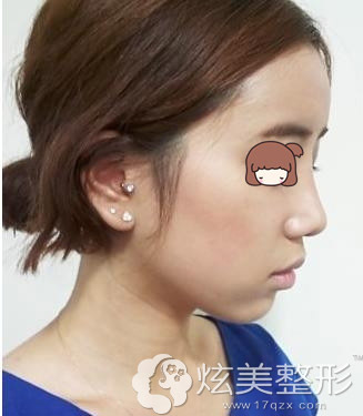 注射隆鼻术后一个月 注射隆鼻术后一个月