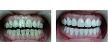 苏州美奥口腔张西云案例分析：四环素牙超薄瓷贴面牙齿美白