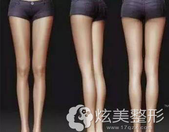 女性都想要拥有好看的腿型