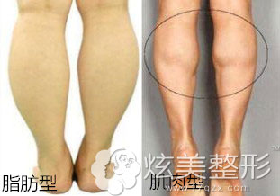 脂肪型腿肌肉型腿区别图