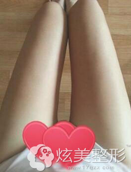 大腿吸脂术后 大腿吸脂术后