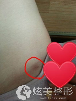 大腿吸脂术后的疤痕位置 大腿吸脂术后的疤痕位置