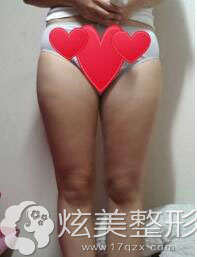 大腿吸脂术前 大腿吸脂术前