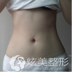 吸脂术后的小蛮腰 吸脂术后的小蛮腰