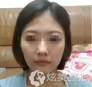 温州和平整形医院注射瘦脸真人案例术前图 温州和平整形医院注射瘦脸真人案例术前图