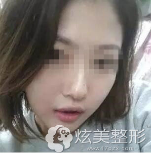 注射瘦脸真人案例术后7天图温州和平整形 注射瘦脸真人案例术后7天图温州和平整形
