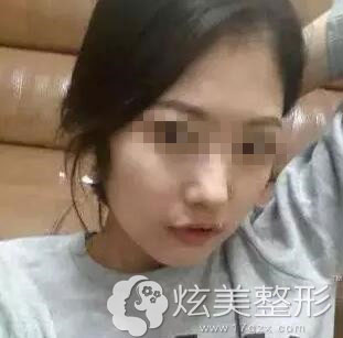 瘦脸真人案例术后15天温州和平整形 瘦脸真人案例术后15天温州和平整形