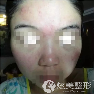 微针祛痘之前的样子 微针祛痘之前的样子