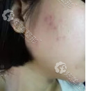 微针祛痘天的面颊 微针祛痘天的面颊
