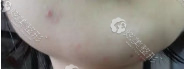 天微针祛痘后的下巴 天微针祛痘后的下巴