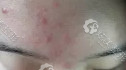 一个疗程的微针祛痘的额头 一个疗程的微针祛痘的额头