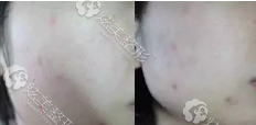 第二次微针祛痘面颊肌肤明显改善 第二次微针祛痘面颊肌肤明显改善