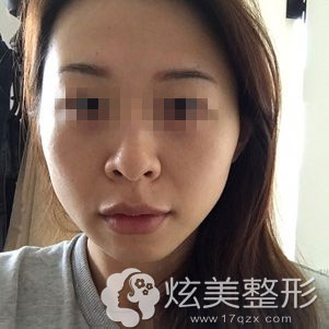 电波拉皮天 电波拉皮天