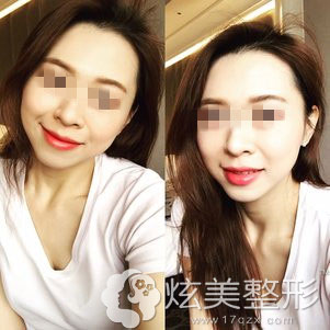 术后15天电波拉皮效果 术后15天电波拉皮效果