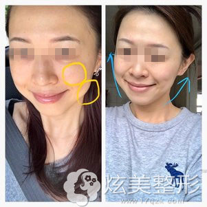 做完电波拉皮后第二天已经能看到效果 做完电波拉皮后第二天已经能看到效果