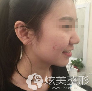 两颊也冒出了好几颗红红的脓包 两颊也冒出了好几颗红红的脓包