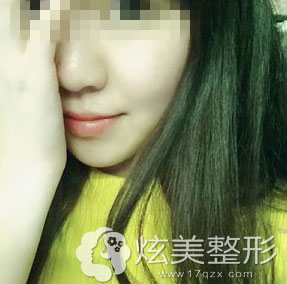 光子嫩肤效果图北京欧华整形 光子嫩肤效果图北京欧华整形