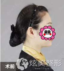 做自体脂肪面部填充前凹陷的额头和太阳穴 做自体脂肪面部填充前凹陷的额头和太阳穴