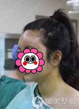术后将脂肪填充面部的样子 术后将脂肪填充面部的样子