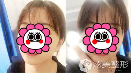 自体脂肪填充面部完全恢复的样子 自体脂肪填充面部完全恢复的样子