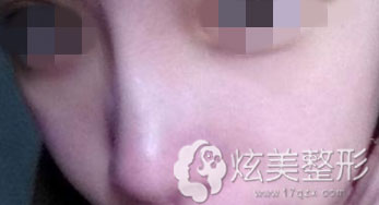 注射隆鼻术后一周效果图 注射隆鼻术后一周效果图