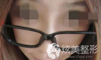 真人案例注射隆鼻术后2周效果图 真人案例注射隆鼻术后2周效果图