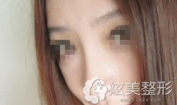 侧面效果图上海天大真人注射隆鼻案例 侧面效果图上海天大真人注射隆鼻案例