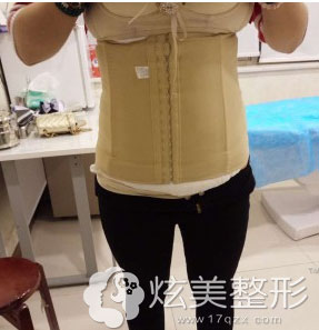 刚做完腹部吸脂手术穿束身衣 刚做完腹部吸脂手术穿束身衣