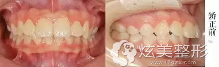 牙齿矫正案例：学生龅牙妹上海万众口腔正畸之路成就齐牙V脸
