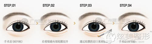 广州曙光激光祛眼袋的操作方法