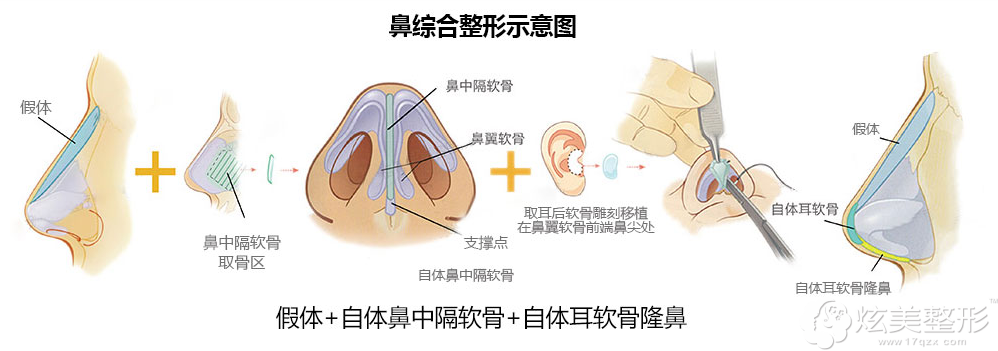 鼻综合整形