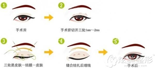 伊恒妍双眼皮手术步骤简易图