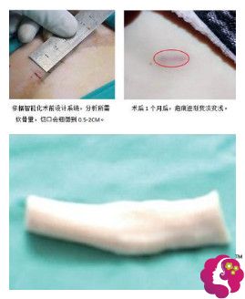 美莱整形医院隆鼻采用的自体肋软骨材料 美莱整形医院隆鼻采用的自体肋软骨材料