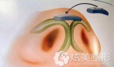 王彪医生告诉你什么是自体真皮垫鼻尖