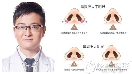 海口瑞韩整形缩鼻头手术原理图以及推荐医生杨永成