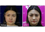 面部脂肪多在广州韩妃做了光纤溶脂瘦脸后get精致小脸