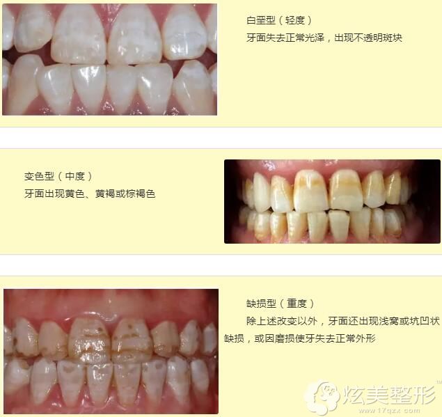 牙齿上釉颜色搭配图片