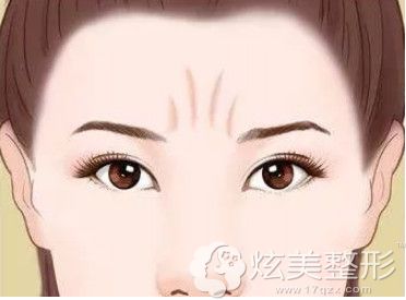 眉間的川字紋怎樣弄掉 Duncaninvet 眉間的川字紋怎樣弄掉 Duncaninvet