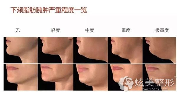 肉肉多下颌缘吸脂好还是面部吸脂好 环吸下颚缘得多少钱 下巴整形 炫美网 肉肉多下颌缘吸脂好还是面部吸脂好 环吸下颚缘得多少钱 下巴整形 炫美网